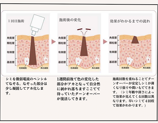 本気シミ改善艶肌スペシャルコース